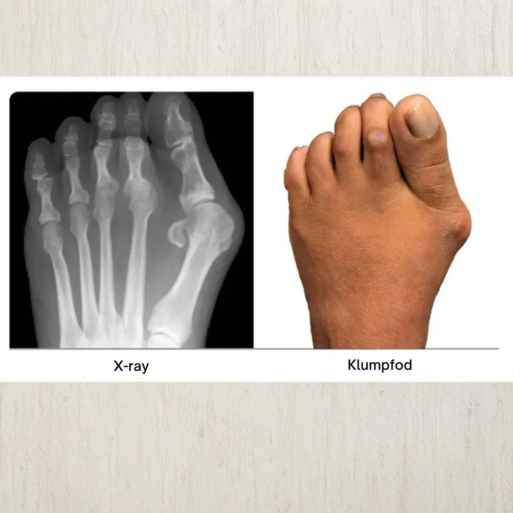 ToeAlign™ | Genskab fodens naturlige balance uden indgreb