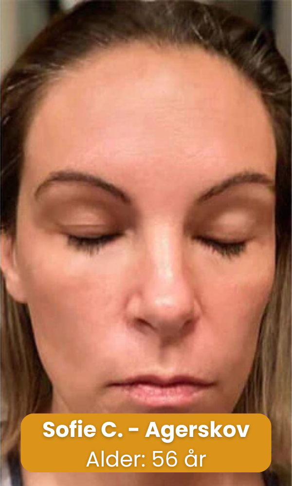 BeeYoung™ | Foryng din hud naturligt – uden nåle eller dyre behandlinger