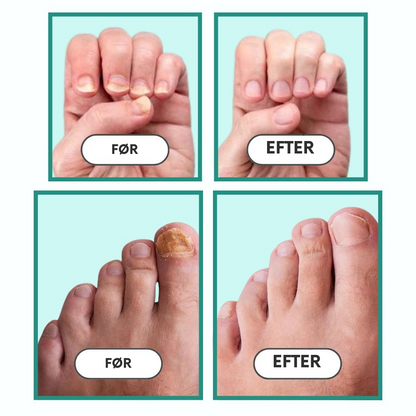 NailCure™ | Ultimativ neglebehandling til sunde, smukke negle