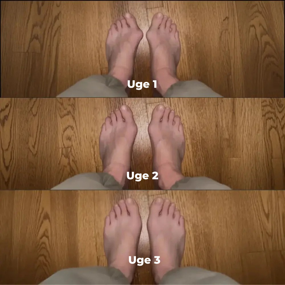 ToeAlign™ | Genskab fodens naturlige balance uden indgreb