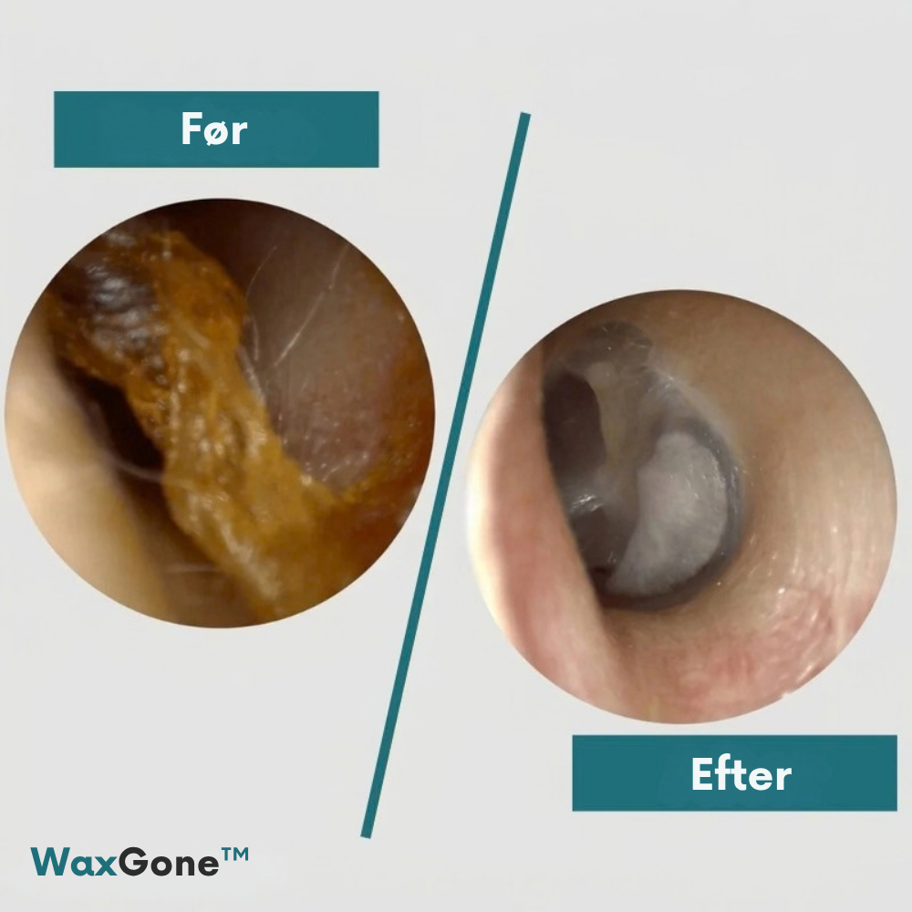 WaxGone™ | Fjern ørevoks skånsomt uden vatpinde