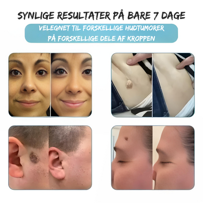 SilkLaser™ | Præcision og blødhed i ét