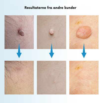 TagPen™ Kit | Fjern hudmærker nemt og skånsomt – hjemme hos dig selv