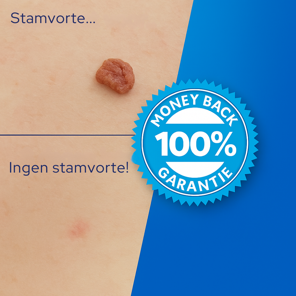 TagErase™ | Sig farvel til stamvorter