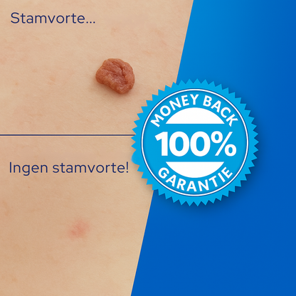 TagErase™ | Sig farvel til stamvorter