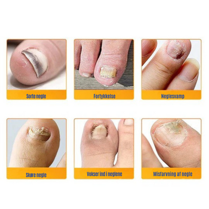 NailRepair™ | Plaster til neglesvamp