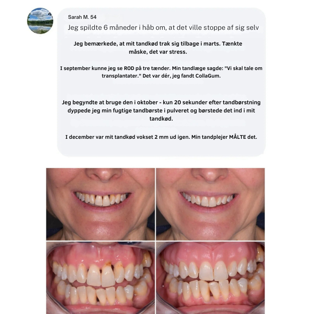 CollaGum™ | Styrk dit tandkød indefra og bevar dit naturlige smil