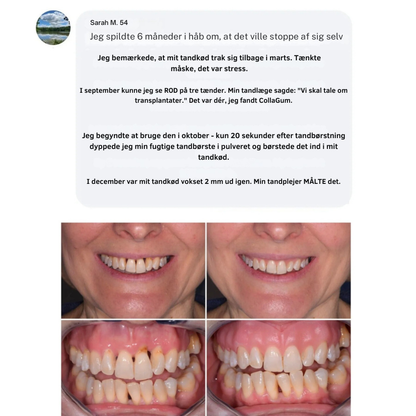 CollaGum™ | Styrk dit tandkød indefra og bevar dit naturlige smil