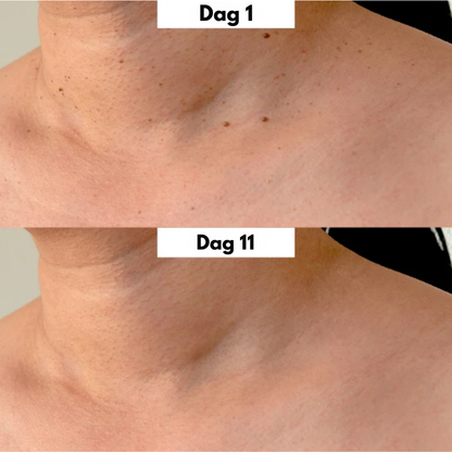 TagPen™ Kit | Fjern hudmærker nemt og skånsomt – hjemme hos dig selv