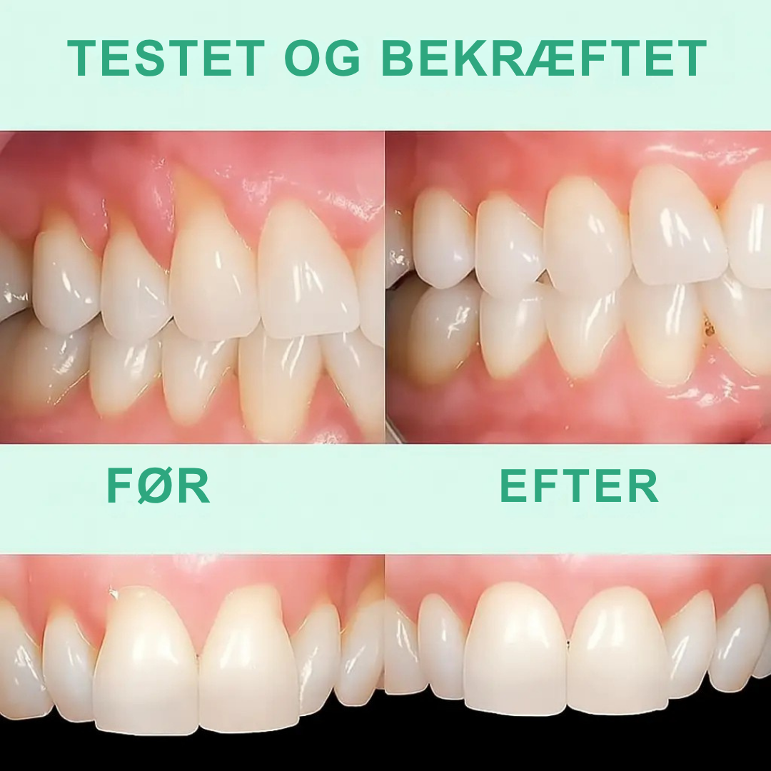 GumVital™ | Synlig bedring af tandkødet på 93%!