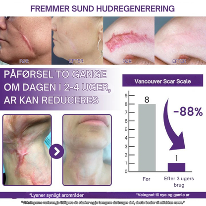 RegenScar™ | Gør synlige ar glattere og mindre fremtrædende