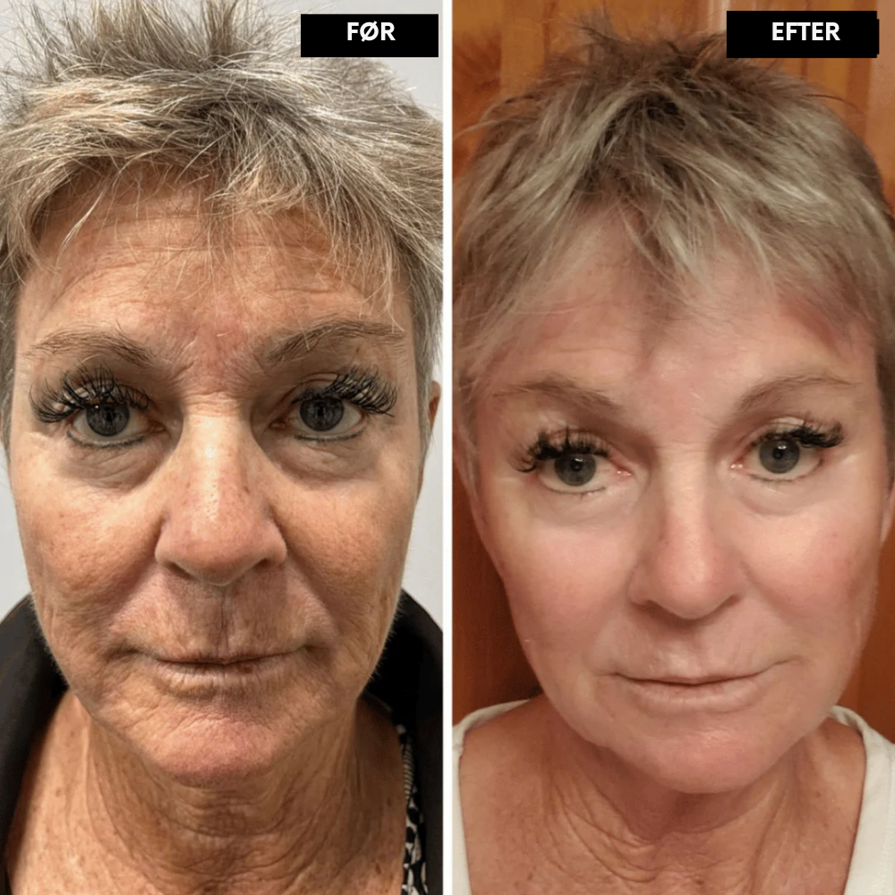 RetinLift™ | Få fastere hud og færre synlige rynker