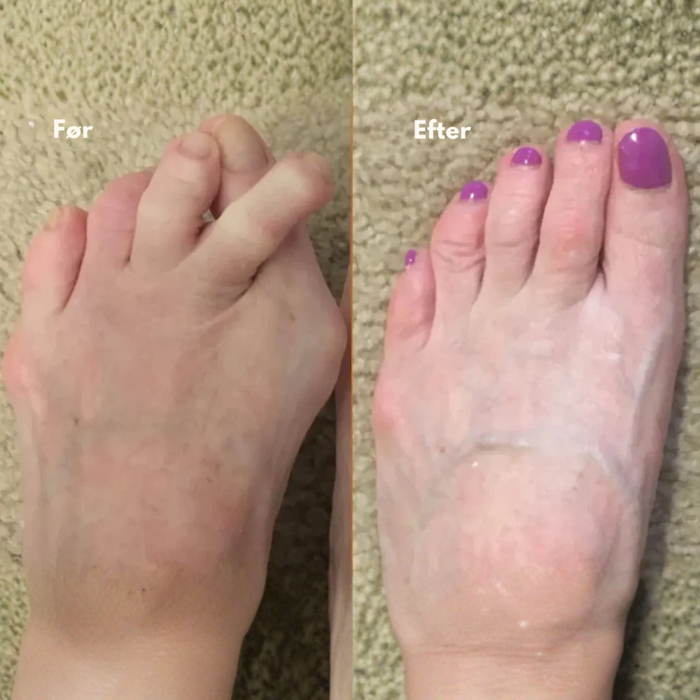 ToeAlign™ | Genskab fodens naturlige balance uden indgreb