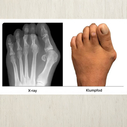 ToeAlign™ | Genskab fodens naturlige balance uden indgreb