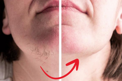 EpiLisse™ | Skånsom hårfjerningscreme til silkeblød hud – uden smerte eller rødme