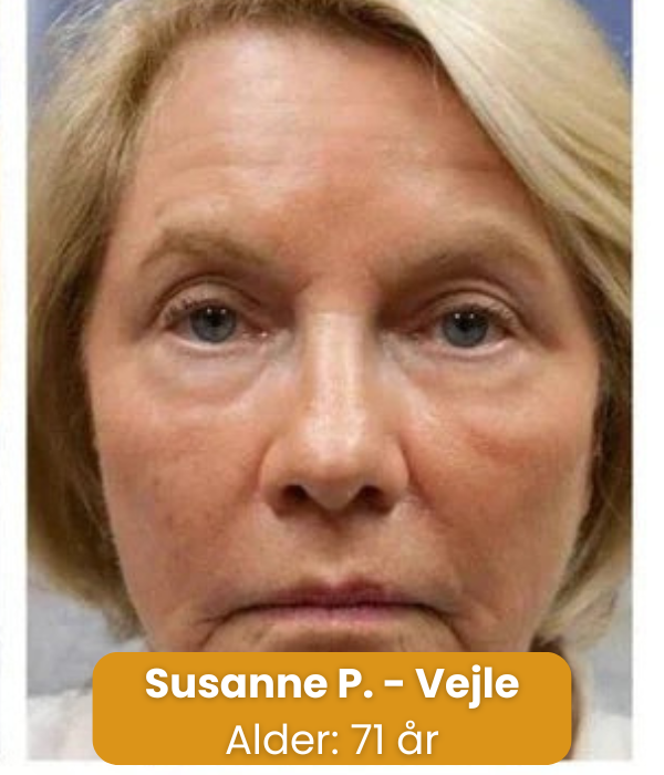 BeeYoung™ | Foryng din hud naturligt – uden nåle eller dyre behandlinger