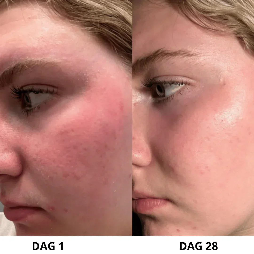 DermaPure™ | Ultralydsskrubber til huden