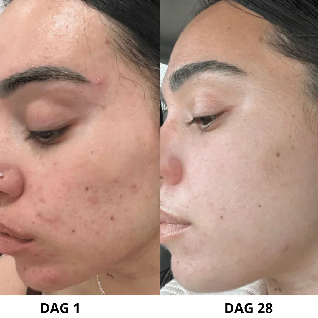 DermaPure™ | Ultralydsskrubber til huden